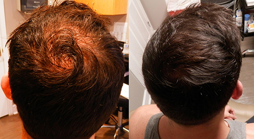 Chronic Pain Lake Mills WI Hair Restoration